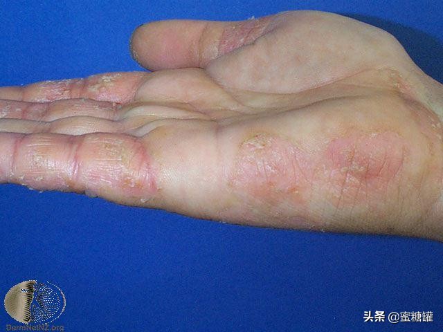 皮肤炎湿疹用药,湿疹性皮肤炎能吃什么药