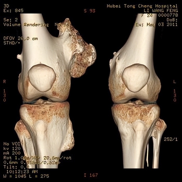 7岁小孩子腿型不好看怎么纠正,三岁小孩腿型需要矫正吗