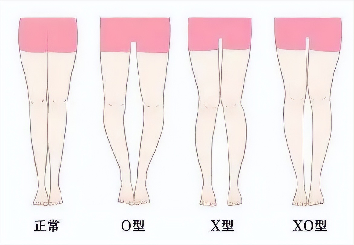 7岁小孩子腿型不好看怎么纠正,三岁小孩腿型需要矫正吗