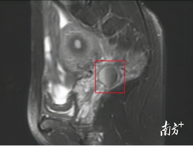 盆腔淤血和子宫息肉能同时治疗吗,老年人宫腔积脓要切除子宫吗