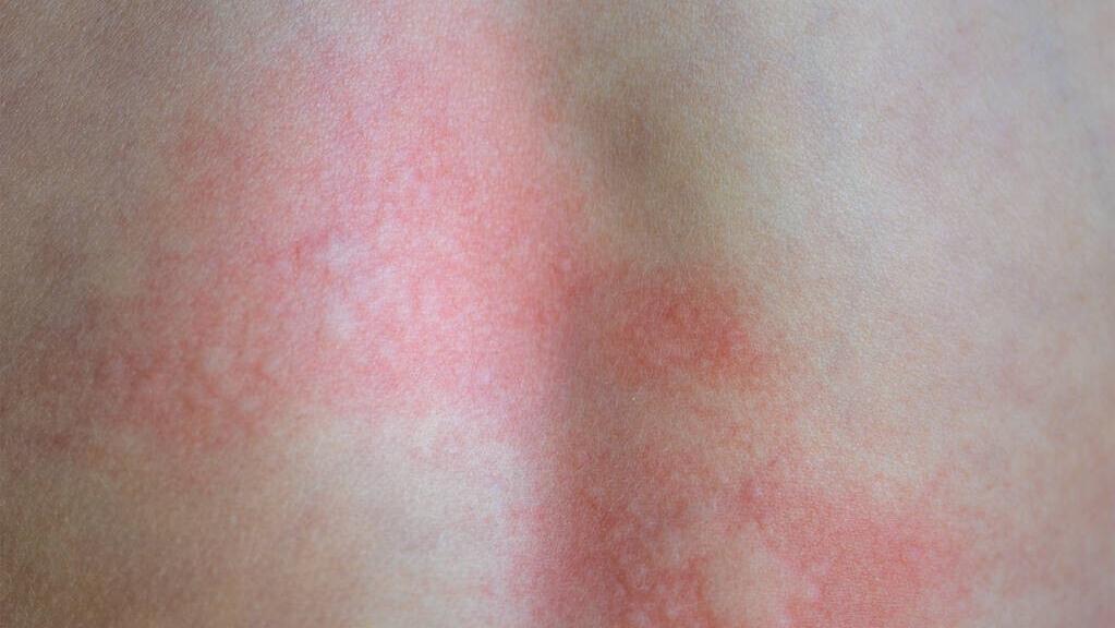 *麻疹荨**的危害有多大？要什么药好的快？医生一次给你讲清楚