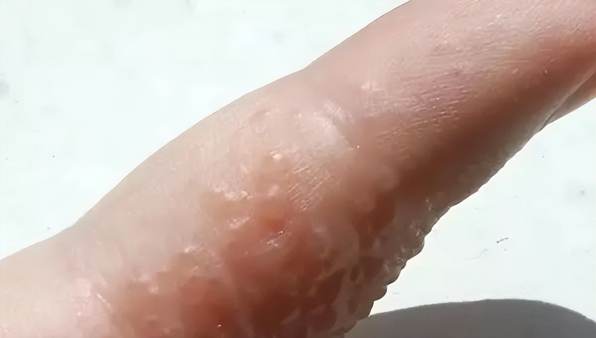 冬天手上汗疱疹怎么根治,协和医院皮肤瘙痒