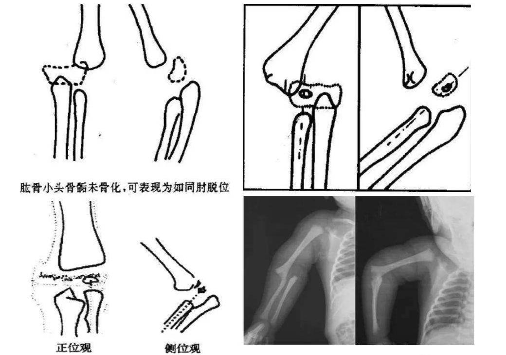 7岁小孩子腿型不好看怎么纠正,三岁小孩腿型需要矫正吗