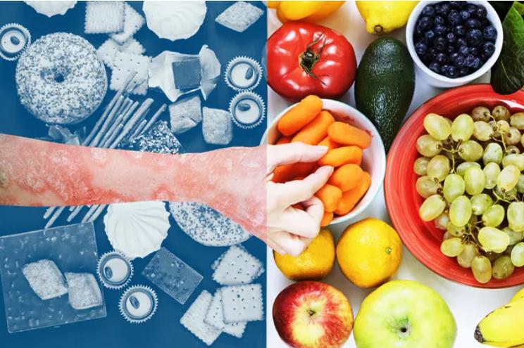 牛皮癣对饮食有什么注意点,牛皮癣饮食有哪些禁忌